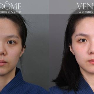 療程效果因人而異，上圖為該案例實際進行 FITme 完形美 客製化3D列印矽膠假體+取肋骨延長鼻中膈+雕鼻頭 之術後效果